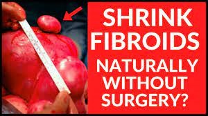 Shrink-Fibroids-naturally-without-surgery