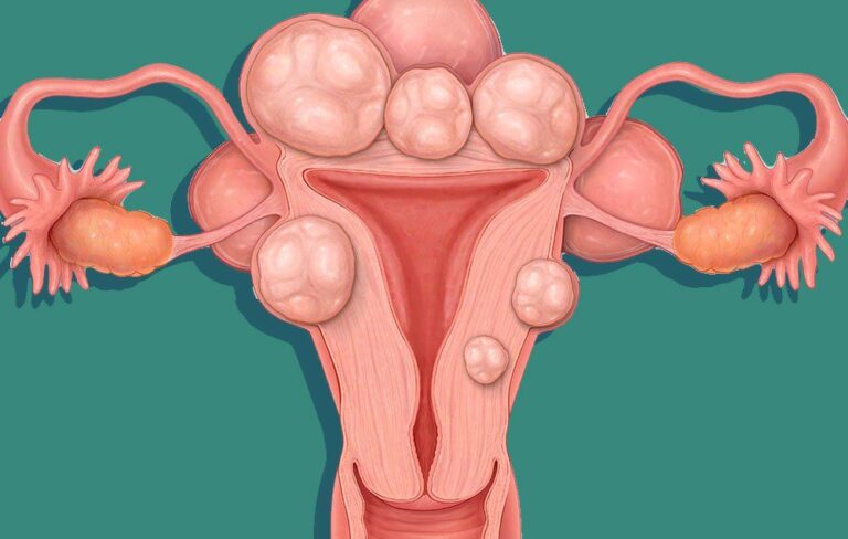 uterine-fibroids-1510752893-1